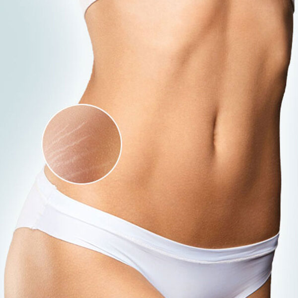 Stretch Mark Treatment