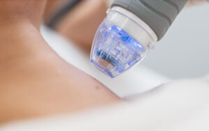 Transform Your Skin: The Amazing Benefits Of RF Micro-Needling