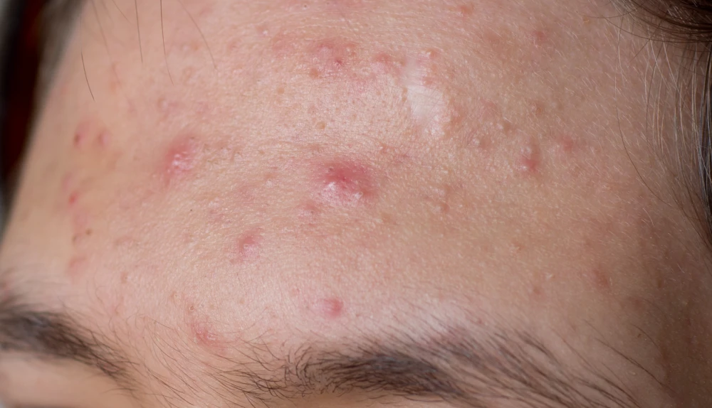 Forehead with visible breakouts needing acne treatments.