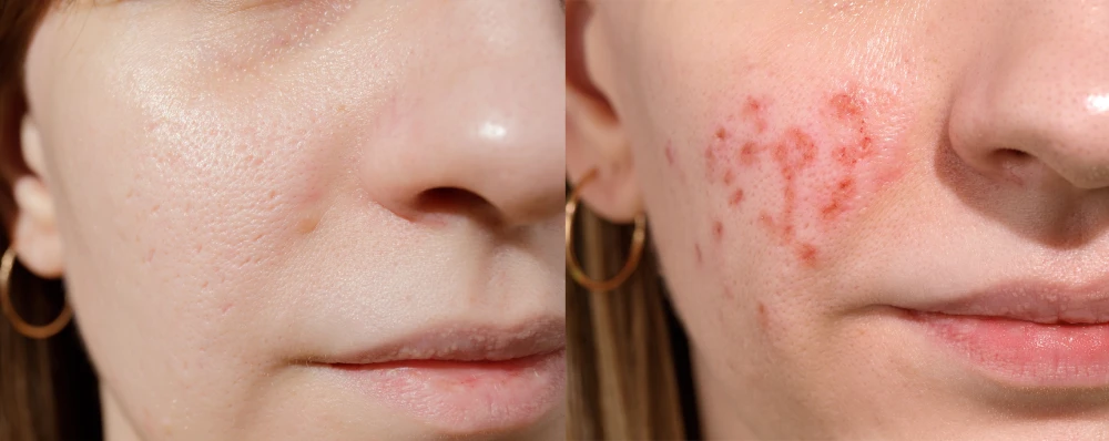 Side-by-side results showing the effects of acne treatments.