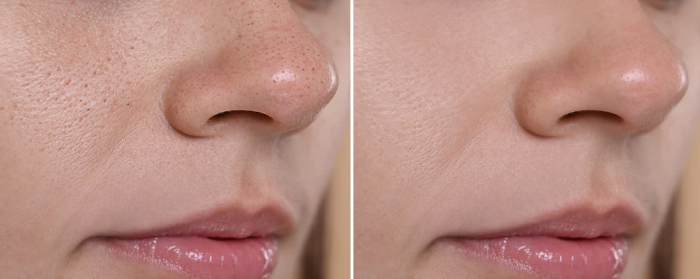 Hydrafacial before and after showing reduced pores and smoother skin texture