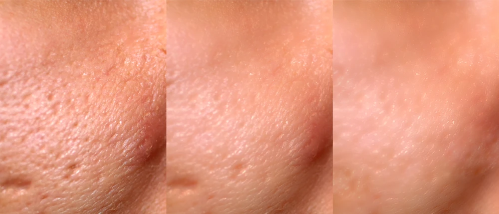 Close-up showing acne scar reduction over time.