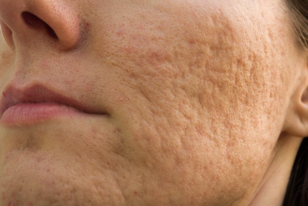 Facial skin with visible acne scarring before treatment.