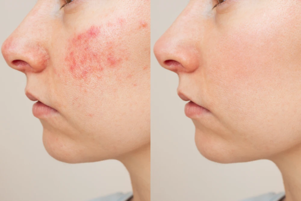 Before and after results of acne treatments on a woman's face.