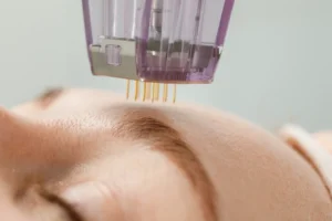Morpheus8 device close-up treating forehead skin.